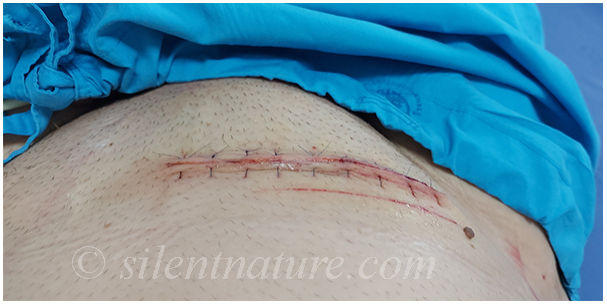 A view of the stitches across my stomach after emergency hernia surgery.